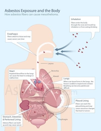 Asbestos Health Issues
